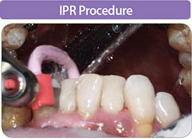 IPR Procedure