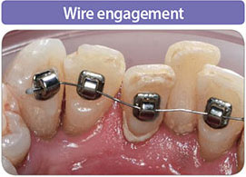 Wire engagement